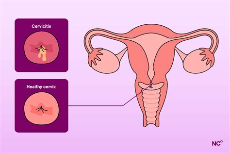 Irritated Cervix Bleeding Started Then From Back Pain To Constipation: