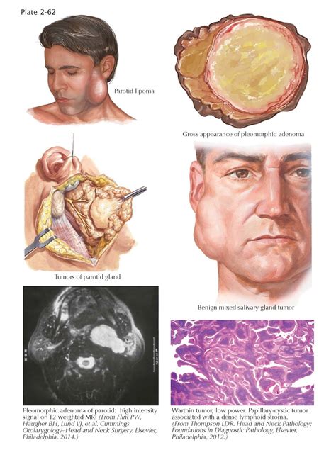Benign Tumors of Salivary Glands - pediagenosis