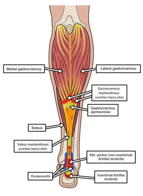 Achilles Tendinitis/Tendinopathy: The pain behind the ankle/heel! - Insoles and Orthotics ...