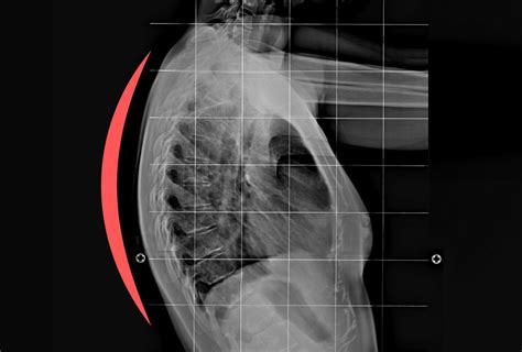 Kyphosis Archives - Spinal Backrack