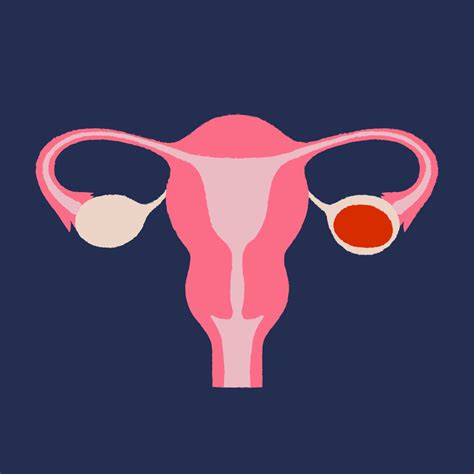 Anteverted/Retroflexed Uterus ? : r/UterusProblems