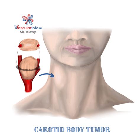 Carotid Body Tumor - Vascular Info
