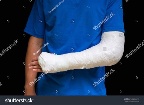 Man Broken Arm Wrapped Medical Cast Stock Photo 1494300839 | Shutterstock