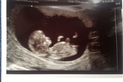 10 Weeks 5 Days Pregnant Ultrasound