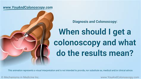 Image result for Loop Colonoscopy