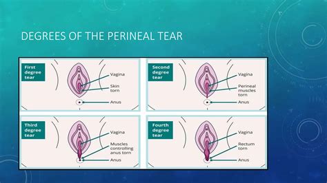 INJURIES TO BIRTH CANAL pptx by devanand hurgule | PPTX