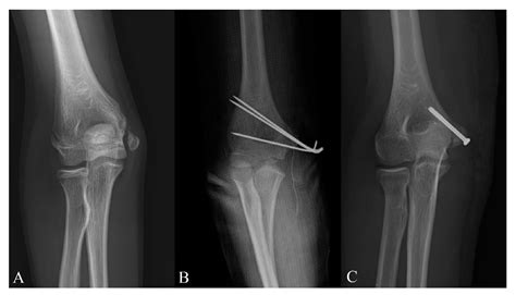 Medial Epicondyle Of The Humerus