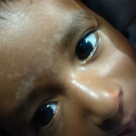 #AskTheExpert Hello My 2.5 year old daughter has white patches on face ...