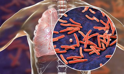 Fight Against Tuberculosis - Mankind Pharma