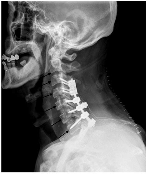 Variation in Prevertebral Soft Tissue Swelling after Staged Combined Multilevel Anterior ... - neck x ray