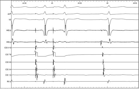 Narrow QRS tachycardia in a 38-year-old female