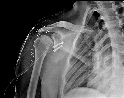 Bankart E Hill Sachs