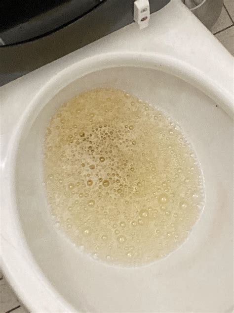 Foamy Urine Rhabdomyolysis at Maddison Loch blog