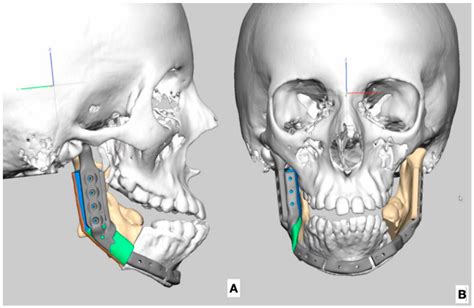 Use of a Fibula Free Flap for Mandibular Reconstruction in Severe Craniofacial Microsomia in ...