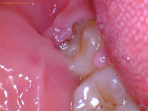 Image result for Tooth Extraction Scar Tissue
