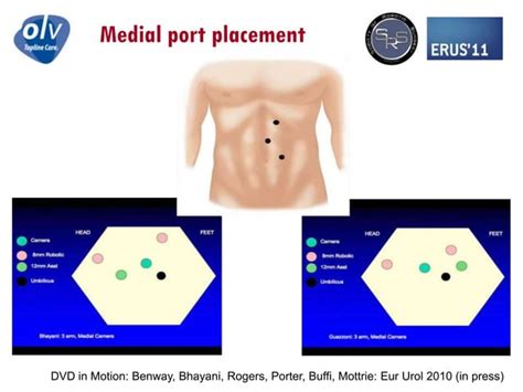 Image result for Nephrectomy Positioning