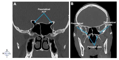 Greater Wing Of Sphenoid Radiograph