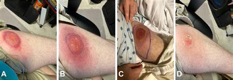 Vesicular Erythema Migrans with Subsequent Jarisch-Herxheimer Reaction Mimicking Cellulitis ...