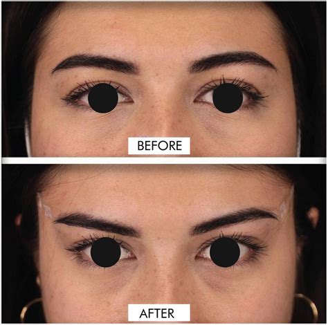 Image result for Thread Brow Lift Procedure