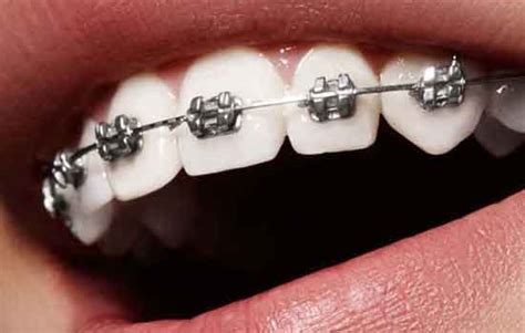 5 important teeth brace care tips to consider - Health Tips