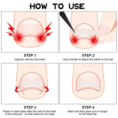 Snapklik.com : 60 Pieces Ingrown Toenail Corrector Strips Ingrown Toe Nail Correction Brace ...