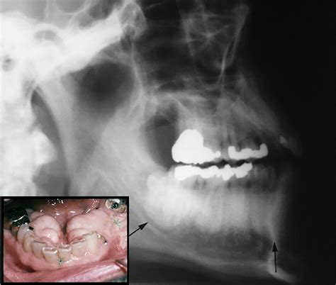 Imaging Torus Lesions of Jaw Bones | Applied Radiology