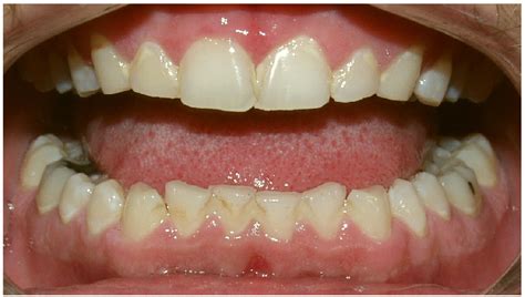 Image result for teeth grinding