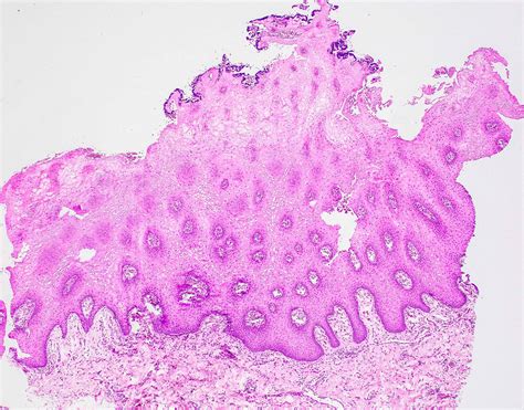 Pathology Outlines - Proliferative verrucous leukoplakia (PVL)