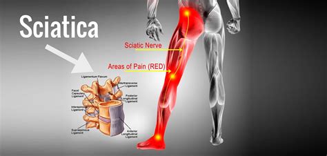 Sciatica Pain Relief Gaithersburg MD | Active Family Chiropractic