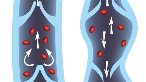 How Do Compression Socks Help Treat Venous Insufficiency? - LymphaTx