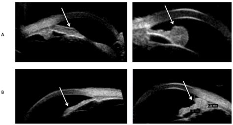 Yield of Multimodal Imaging in Iris Amelanotic Lesions: A Masked Case ...
