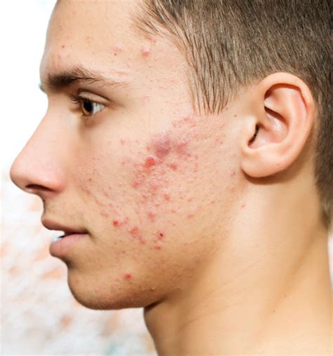 How To Deal With Painful Adult Acne