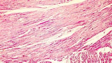 Erster direkter Therapieansatz bei HOCM - Kardiologie & Gefäßmedizin ...