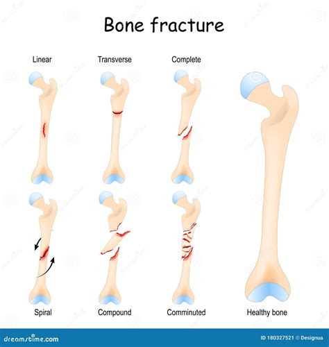 Types Of Leg Fractures – Types Of Fractures – SRYQ
