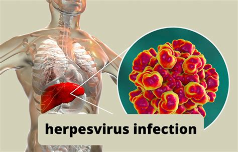 Herpes virus infections linked to development of diabetes among ...
