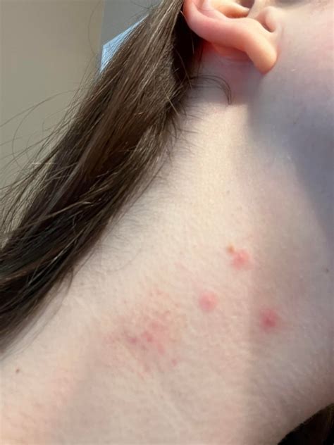 Help!! Not acne prone at all, will get occasional pimples but have never had anything like this ...
