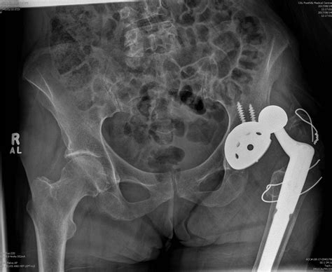 Hip Replacement Dislocation - Adam Watson Orthopaedic Surgeon