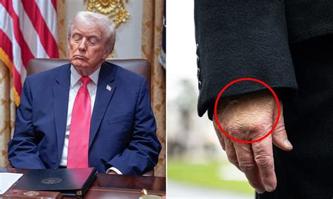 "Superstitious" Trump says higher aspirin dosage behind hand bruises