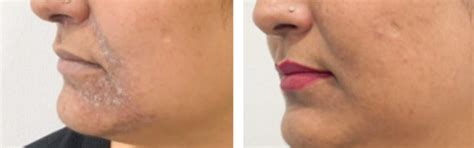 Small Patches - Eczema and Psoriasis Care Bundle – Oleum Cottage