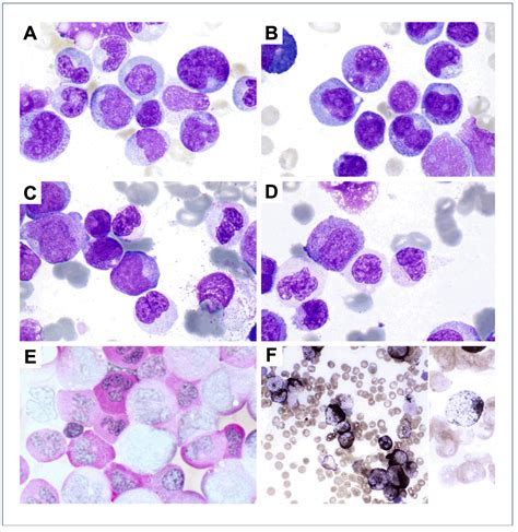 Acute Monocytic Leukemia Acute Myeloid Leukemia With