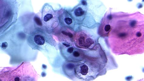 Low grade squamous intraepithelial lesion (LSIL) | MyPathologyReport