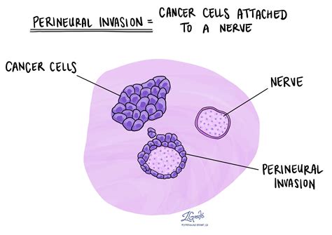 Your pathology report for cholangiocarcinoma | MyPathologyReport