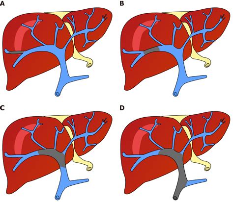 Portal Vein Thrombosis Anatomy