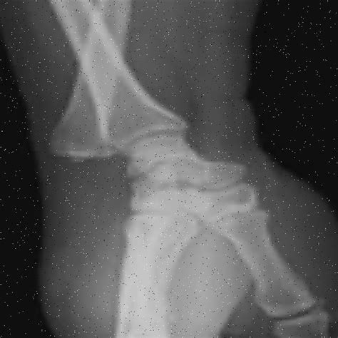 Bone Fracture Detection Using Image Processing Source Code GitHub 的图像结果