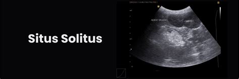 Situs Solitus: Normal Organ Placement in Medicine