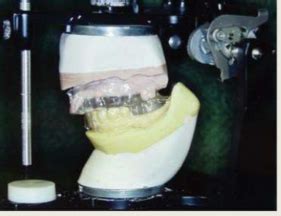 Image result for Two Walled Defect Perio