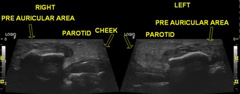 Image result for Heart Block Algorithm