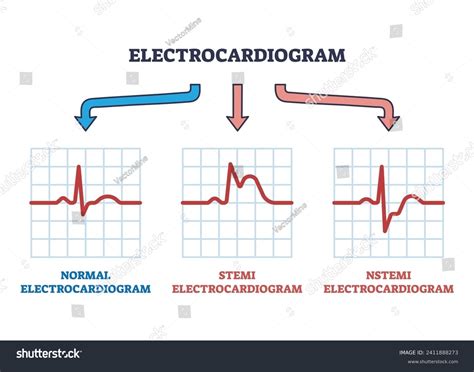 Electrocardiogram Stemi Nstemi Abnormal Heart Rate Stock Vector (Royalty Free) 2411888273 ...