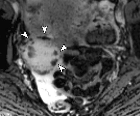 Susceptibility-Weighted MRI of Endometrioma: Preliminary Results | AJR