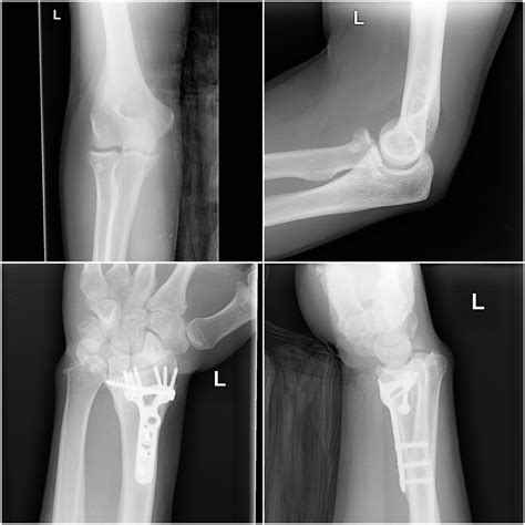 Essex-Lopresti fracture - WikiProjectMed